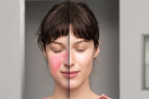 Understanding Rosacea