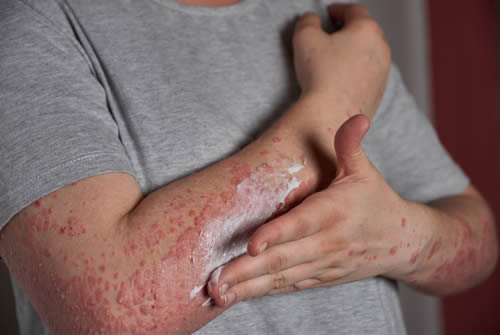 Psoriasis Explained