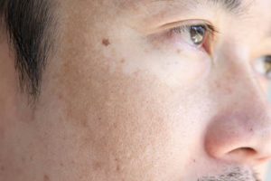 sun damaged skin face