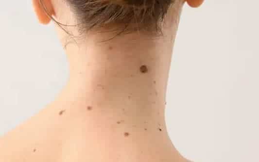 What You Need to Know About Moles