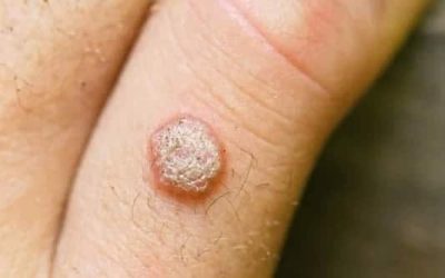 Curious About Warts Here’s What You Should Know