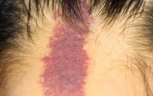 Demystifying Birthmarks