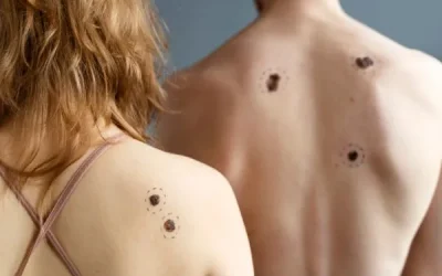 Skin Tags: Symptoms, Causes, and Treatment Options