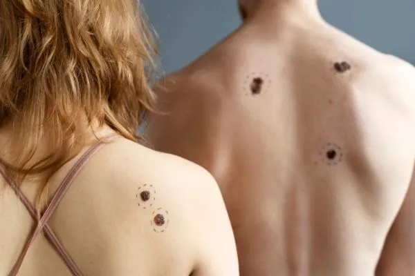 Skin Tags: Symptoms, Causes, and Treatment Options