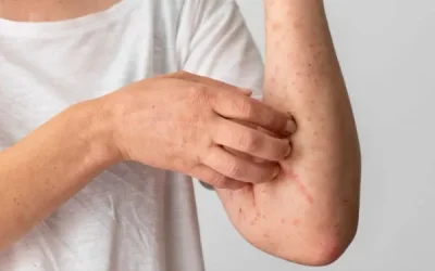 Psoriasis