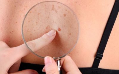 Understanding Skin Tags