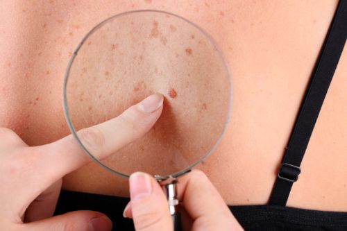 What Are Skin Tags?