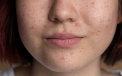 Rosacea Tips and Treatments for Achieving Clearer Calmer Skin