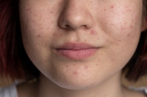 rosacea